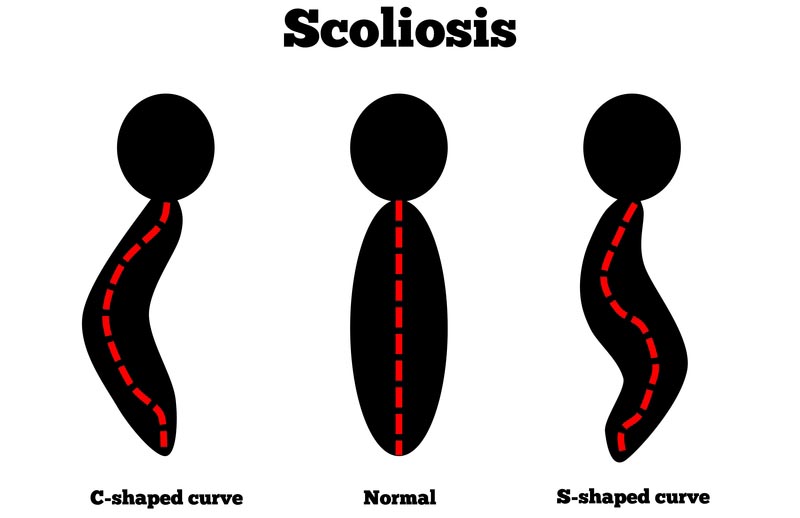 New York, NY scoliosis treatment